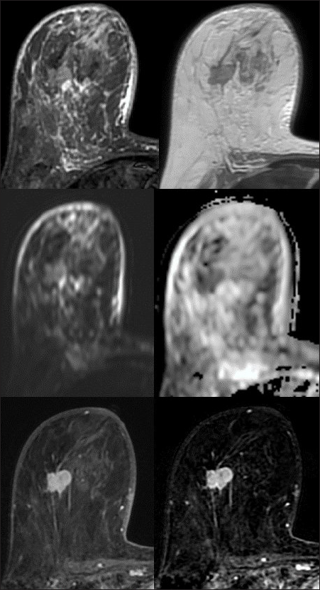 Invasive ductal carcinoma – nonspecial type. HER2 enriched molecular subtype. A 46-year-old female with a lump in the right axilla. MRI revealed enlarged right breast. An irregular shaped mass with non-circumscribed margins in the middle third depth of the right breast. The mass is predominantly hyperintense on T2 and STIR images, and shows diffusion restriction with ADC values in the range of 0.3–0.4 × 10–3 mm2/s. It is showing moderate heterogeneous enhancement. Diffuse STIR hyperintensity in the fibroglandular tissue, pectoralis muscle, and subcutaneous planes.