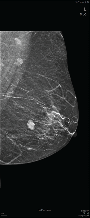 Mediolateral oblique view mammogram of the left breast showing fairly well-circumscribed high-density mass with microlobulated margins in the lower outer quadrant.