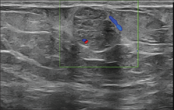 Color doppler image showing minimal internal and peripheral vascularity.