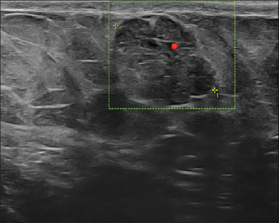 Color doppler image showing minimal internal vascularity.