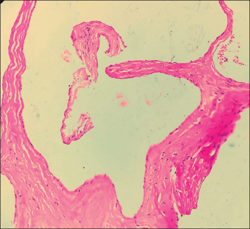 40×: Section shows dilated blood vessels lined by benign endothelial cells.