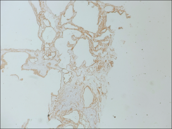 Lesional cells show immunoreactivity for CD34 suggesting endothelial cell origin of dilated tissue.