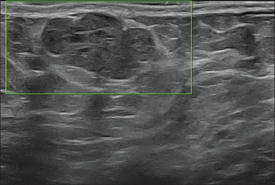 On 6-month follow-up, ultrasound revealed no demonstrable vascularity.