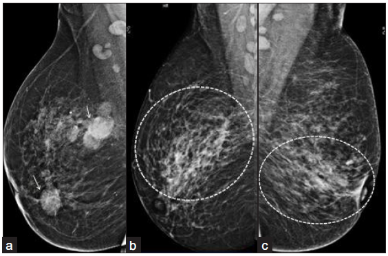 (a) Right breast mammogram MLO view of a 38-year-old female showing, multiple circumscribed, high density masses in upper central and inner quadrant (white arrows) with scattered, benign, calcific foci and axillary lymph nodes. (b) Right breast mammogram (MLO view of another 36-year-old female showing focal asymmetry (outer and central quadrant) with surrounding trabecular thickening (dotted circular area). Left breast mammogram MLO view (c) of a 33-year-old female showing architectural distortion and trabecular thickening (dotted circular area). MLO: Mediolateral oblique.