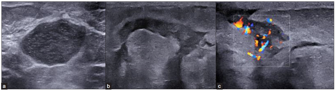 (a) Left breast USG image of a 30-year-old female, (b) Showing a well-defined, cystic lesion with thick internal echoes and posterior enhancement suggesting formed abscess. Left breast USG of a 31-year-old female, (c) Showing tracking fluid channels with increased vascularity on color Doppler. USG: Ultrasonography.