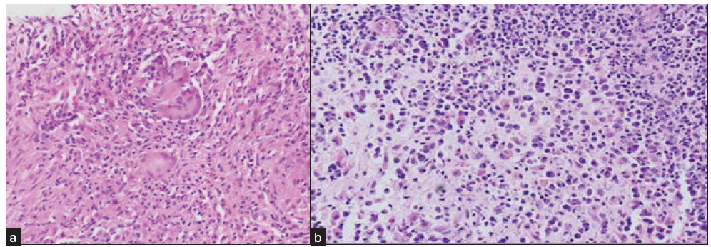 Photomicrographs of breast biopsy (H&E stain, 200x) shows (a) epithelioid cell granulomas with multinucleated giant cells suggestive of CGM, (b) dense lympho-plasmacytic infiltrates without any well-formed granulomas diagnostic of NGM. H&E: Hematoxylin and eosin, CGM: Chronic granulomatous mastitis, NGM: Nongranulomatous mastitis.