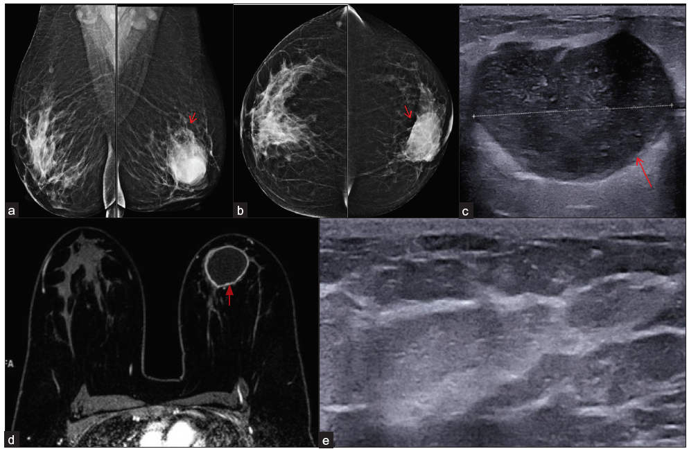 Tubercular mastitis (Gene Xpert and culture positive) in a 38-year-old lady, bilateral mammogram mediolateral oblique (a) and cranio-caudal (b) views showing an oval circumscribed high density mass involving left breast lower inner quadrant (red arrows). B-mode ultrasound image (c) showing oval hypoechoic circumscribed mass (red arrow) with posterior acoustuic enhancement and moving internal echoes s/o abscess. The horizontal white line through the abscess represents its diameter. (d) Dynamic contrast enhanced -MRI image shows a large abscess (red arrow). B-mode ultrasound image (e) at six months of Anti-tubercular therapy shows complete resolution of the abscess.