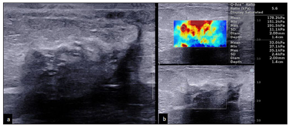 A 55-year-old with ductal carcinoma in situ (DCIS) presenting as non-mass abnormality and low elastography values. (a) B-mode 2D ultrasound image showing a hypoechoic non-mass abnormality with posterior acoustic shadowing. (b) Elastography image showing peripheral hardness with lower elastography values (mean: 178 kPa, minimum: 151 kPa, and maximum: 192 kPa).