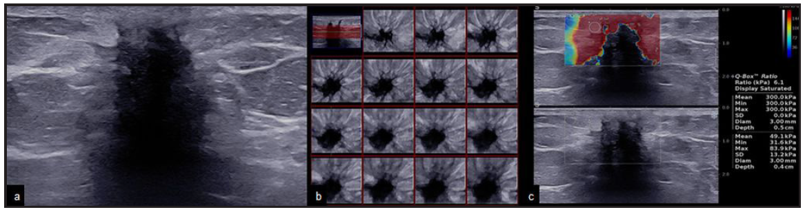 A 59-year-old with hormone receptor-positive breast cancer. The mass shows spiculated margins and high elastography values. (a & b) B-mode 2D and 3D ultrasound images showing an irregular hypoechoic mass with spiculated margins and posterior acoustic shadowing. (c) Elastography image showing peripheral hardness of the lesion with high elastography values (mean: 300 kPa, minimum: 300 kPa, and maximum: 300 kPa).