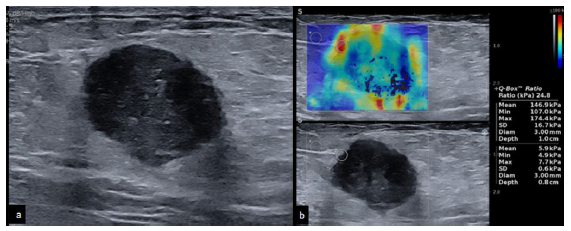 A 40-year-old with triple negative breast cancer. The mass shows circumscribed margins and low elastography values. (a) B-mode 2D ultrasound image showing a round hypoechoic mass with circumscribed margins and posterior acoustic enhancement. (b) Elastography image showing peripheral hardness of the lesion with lower elastography values (mean: 147 kPa, minimum: 107 kPa, and maximum: 174 kPa).