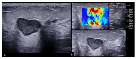 A 45-year-old with hormone receptor-positive breast cancer. The mass shows circumscribed margins and low elastography values. (a) B-mode 2D ultrasound image showing an oval hypoechoic mass with circumscribed margins and posterior acoustic enhancement. (b) Elastography image showing peripheral hardness of the lesion (suspicious lesion despite the benign morphology) with lower elastography values (mean: 183 kPa, minimum: 152 kPa, and maximum: 201 kPa).