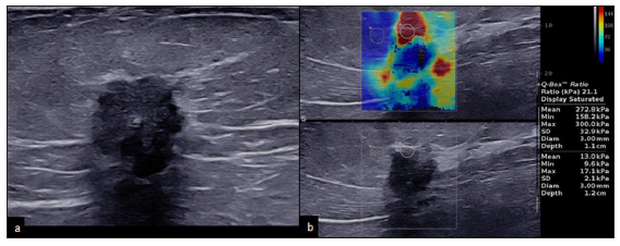 A 65-year-old with triple negative breast cancer. The mass shows spiculated margins and high elastography values. (a) B-mode 2D ultrasound image showing an irregular hypoechoic mass with spiculated margins and posterior acoustic shadowing. (b) Elastography image showing peripheral hardness of the lesion with higher elastography values (mean: 273 kPa, minimum: 158 kPa, and maximum: 300 kPa).