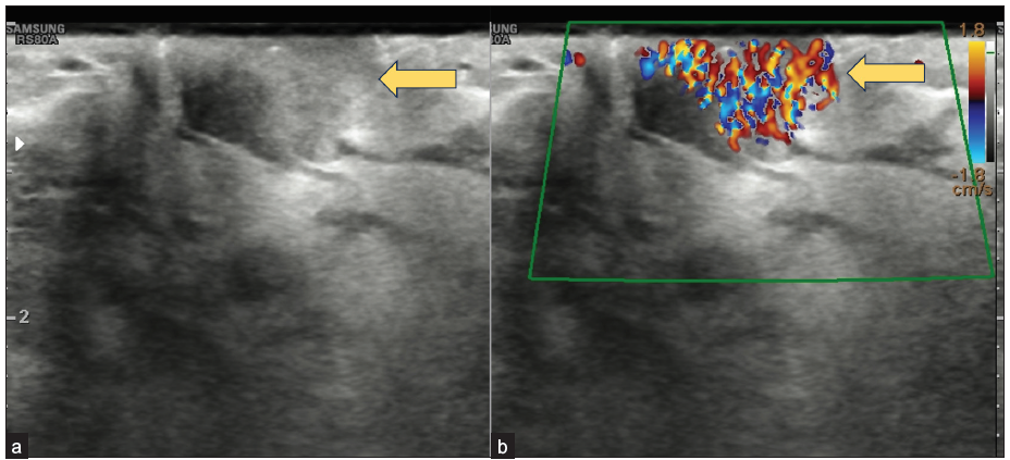 Transverse ultrasound of the left nipple: (a) an isoechoic 1.8 × 1.6 cm, ovoid mass with indistinct margins within the left nipple (yellow arrow), with (b) extensive internal vascularity (yellow arrow) on color Doppler.