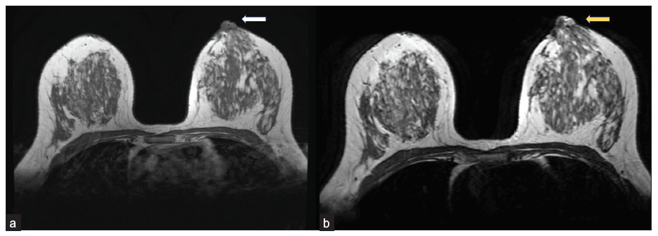 On Magnetic Resonance Imaging (MRI), a circumscribed focal lesion of size 18 × 14 × 16 mm is seen within the left nipple, predominantly involving lateral half of the nipple. (a) shows intermediate signal intensity on T1WI (white arrow) and (b) shows heterogeneous hyperintensity (yellow arrow) on T2WI.