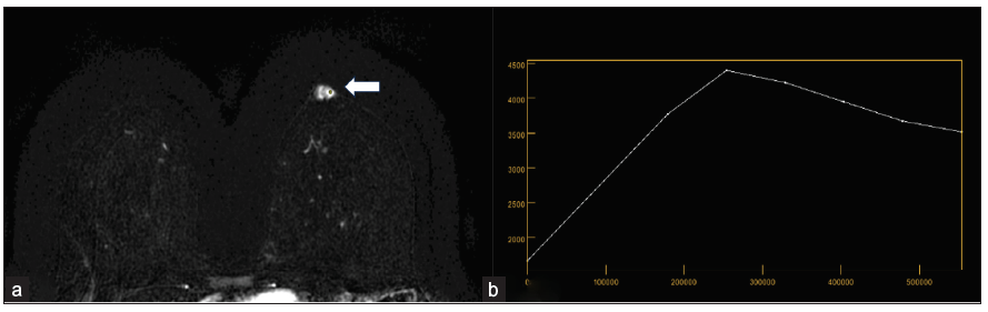 On axial Magnetic Resonance Imaging (MRI) post contrast dynamic study, in (a) the lesion demonstrates intense enhancement (white arrow) and in (b) the lesion demonstrates type 2 kinetic curve.