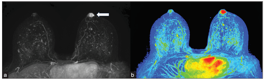 (a) Axial maximum intensity projection (MIP) image of first post contrast Magnetic Resonance Imaging (MRI) subtraction shows asymmetric strong enhancement (white arrow) of the left nipple on grey scale and on (b) color coded maps.