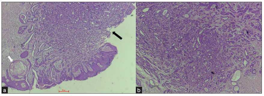 (a) Photomicrograph of the left nipple biopsy showing focal erosion of the stratified squamous epithelium (black arrow). The underlying dermis shows an unencapsulated, circumscribed area of adenosis. A keratin cyst is also seen (white arrow). (H&E; 40x) (b) Benign proliferation of small ducts in a sclerotic stroma. Some of the duct lumina show eosinophilic secretions. (H&E; 40x). H&E: Hematoxylin and Eosin.