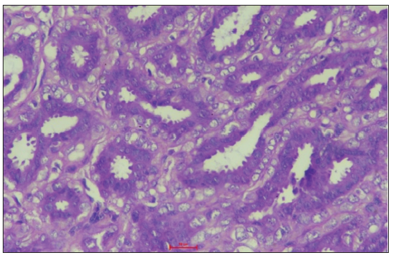 The ducts are lined by cytologically bland epithelial and myoepithelial cells. Prominent apocrine change is seen in the epithelial cells. (H&E; 400x). H&E: Hematoxylin and Eosin.