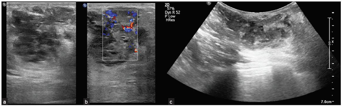 (a) Irregular shaped lesion with microlobulated margins, oriented parallel to the breast parenchyma with few cystic areas within. (b) On colour doppler (white box: color box in the region of interest), there is significant internal vascularity. (c) The lesion shows posterior acoustic enhancement. Ill-defined, irregular, heterogeneously hypoechoic lesion with lobulated margins, showing posterior acoustic enhancement and significant internal vascularity is seen with few cystic areas in the lesion. The lesion was suspicious for malignancy --- Breast Imaging Reporting and Data system (BIRADS) IV lesion.