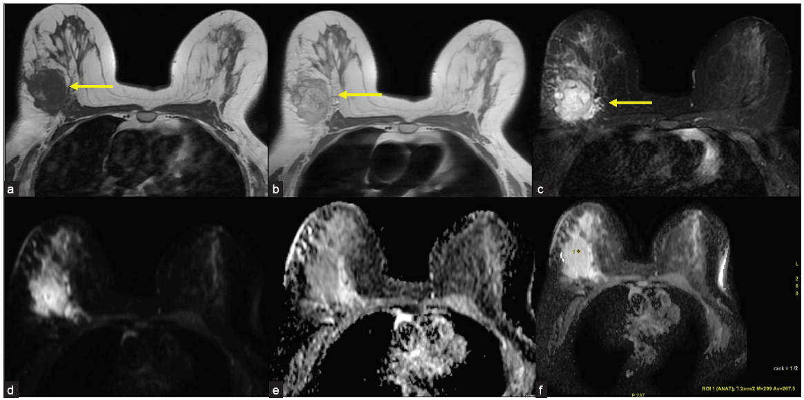 (a) Axial T1 images showing hypointense lesion (yellow arrow) in the upper and outer quadrant of right breast. (b) Axial T2 images showing hyperintense lesion (yellow arrow). (c) Axial STIR images showing hyperintense lesion with significant edema (yellow arrow). (d-f) Lesion showing diffusion restriction with low ADC values of 0.2 × 10-6 mm/s.