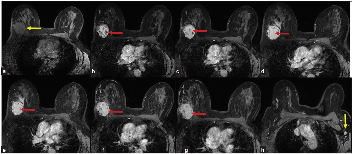 (a) Precontrast fat suppressed T1 images showing a hypointense lesion (yellow arrow). (b-g) Images of postcontrast fat suppressed T1 images from phase 1 to phase 6 showing intensely enhancing lesion (red arrows) with few non enhancing areas. (h) Enhancing suspicious level I axillary lymph node (yellow arrow) with nodular cortical thickening in the left axilla.