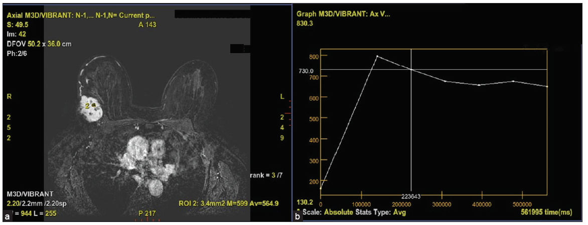 (a) Figure showing contrast enhanced post processed image with selected ROI. (b) Figure showing type III kinetic curve demonstrating initial rapid uptake and washout in delayed phase. ROI: region of interest.