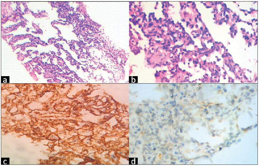 (a) Low Power H&E (100x) Tumor shows branching dilated vascular channels lined by plump endothelial cells. (b) High power H&E (400x) Tumor cells show hyperchromatic nucleus and focal tufting of endothelial cells. (c) IHC CD34 (400x) - Strong positive in tumor cells. (d) IHC PanCK (400x) - Negative in tumor cells. H&E: hematoxylin and eosin, IHC: immunohistochemistry, CD: cluster of differentiation.