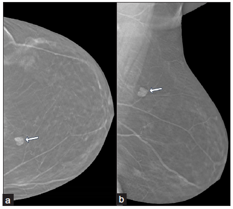 (a-b) Tomosynthesis images of left breast in craniocaudal and mediolateral oblique views show an irregularly shaped high density lesion (white arrows) with microlobulated margins in the upper inner quadrant. The tomosynthesis slice number (43/62 in craniocaudal view and 55/72 in mediolateral oblique view) denotes the superficial location of the lesion.