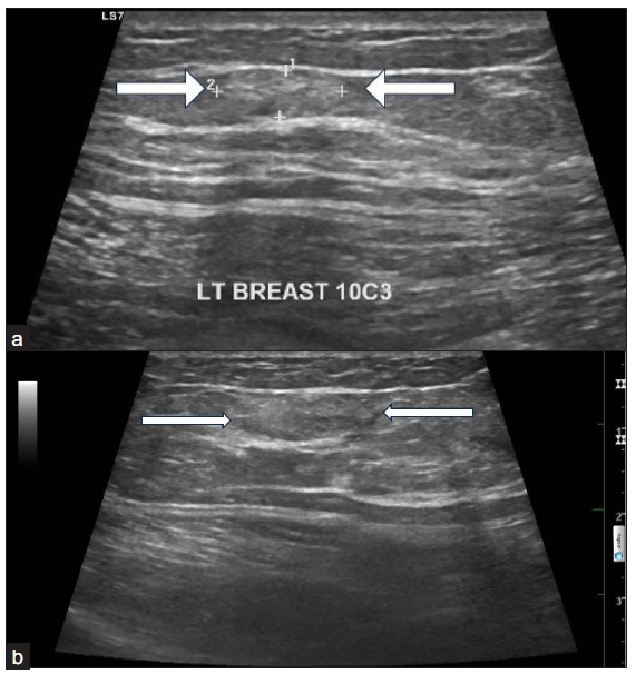 (a-b) Grey scale USG images reveals an irregularly shaped, subtle iso to mildly hyperechoic lesion with microlobulations in parallel orientation in the superficial plane (white arrows). USG: ultrasound.