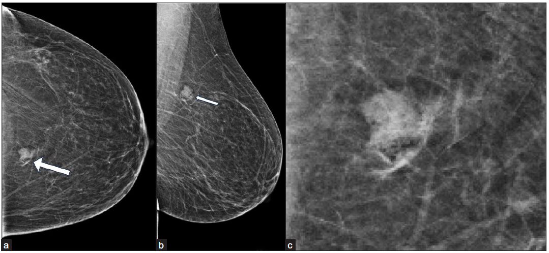 (a-b) Left breast mammogram—craniocaudal and mediolateral oblique views—after intralesional injection of contrast shows streaks of contrast in and around the lesion (white arrow). (c) Magnified image of the same lesion in left breast mammogram—craniocaudal view—after intralesional injection of contrast shows streaks of contrast in and around the lesion.