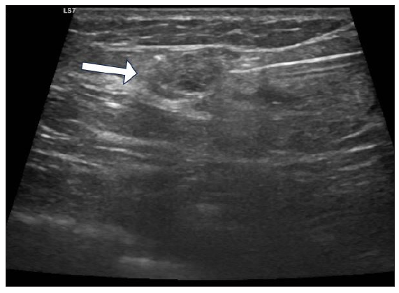 USG-guided core biopsy of the lesion (white arrow). USG: ultrasound.