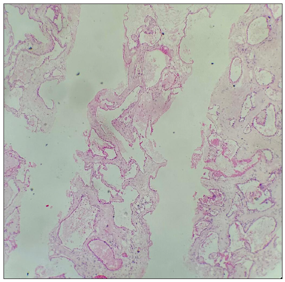 Multiple linear cores showing a neoplasm composed of large, dilated, thin-walled blood vessels (Hematoxylin and Eosin stain 4x).