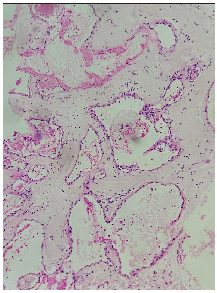 Large, dilated, congested, thin-walled blood vessels lined by flat endothelium (Hematoxylin and Eosin stain 10x).