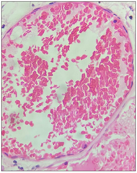 High power view showing congestion and flat endothelial lining cells (Hematoxylin and Eosin stain 40x).