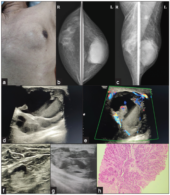 A 72-year male with a complaint of a lump in left breast for six months, (a) displacing nipple-areolar complex toward left (b, c) MLO and CC view showing diffuse gynecomastia on the right side, and oval shape, circumscribed, high-density lesion involving left breast extending from subareolar to posterior third region with nipple retraction and overlying skin thickening along with axillary lymph node enlargement. (d, e) Ultrasound examination reveals a complex solid cystic lesion with peripheral and center vascularity (f) increased eccentric cortical thickness of lymph node, (g) and biopsy of the solid portion after fluid aspiration, turned out to be a case of (h) IDC grade III, seen in histopathology picture.