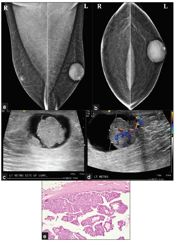 Intracystic papillary carcinoma (a, b) MLO and CC view showing oval shape, circumscribed margin, high density subareolar eccentric lesions in the left breast. (c, d) Ultrasound shows irregular shape mass with indistinct margin, parallel in orientation, complex solid cystic pattern with areas of vascularity within the solid component, and posterior acoustic enhancement. (e) Histopathology showing intracystic tumor arranged in a tubulo-papillary pattern.