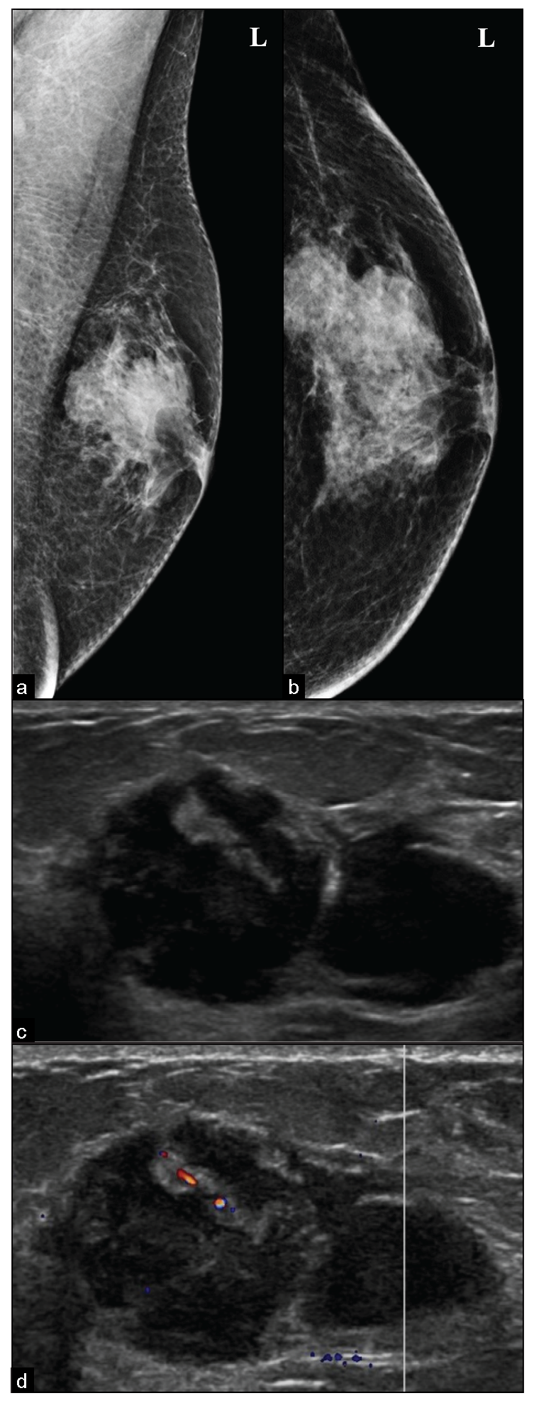 Diagnosed case of Plasmacytoma, (a, b) presenting as an irregular microlobulated, high density, subareolar eccentric mass in the left breast, seen in mammography. (c, d) Ultrasound shows an irregular, microlobulated, heterogeneous mass with parallel in orientation and focal vascularity within it and no posterior features.