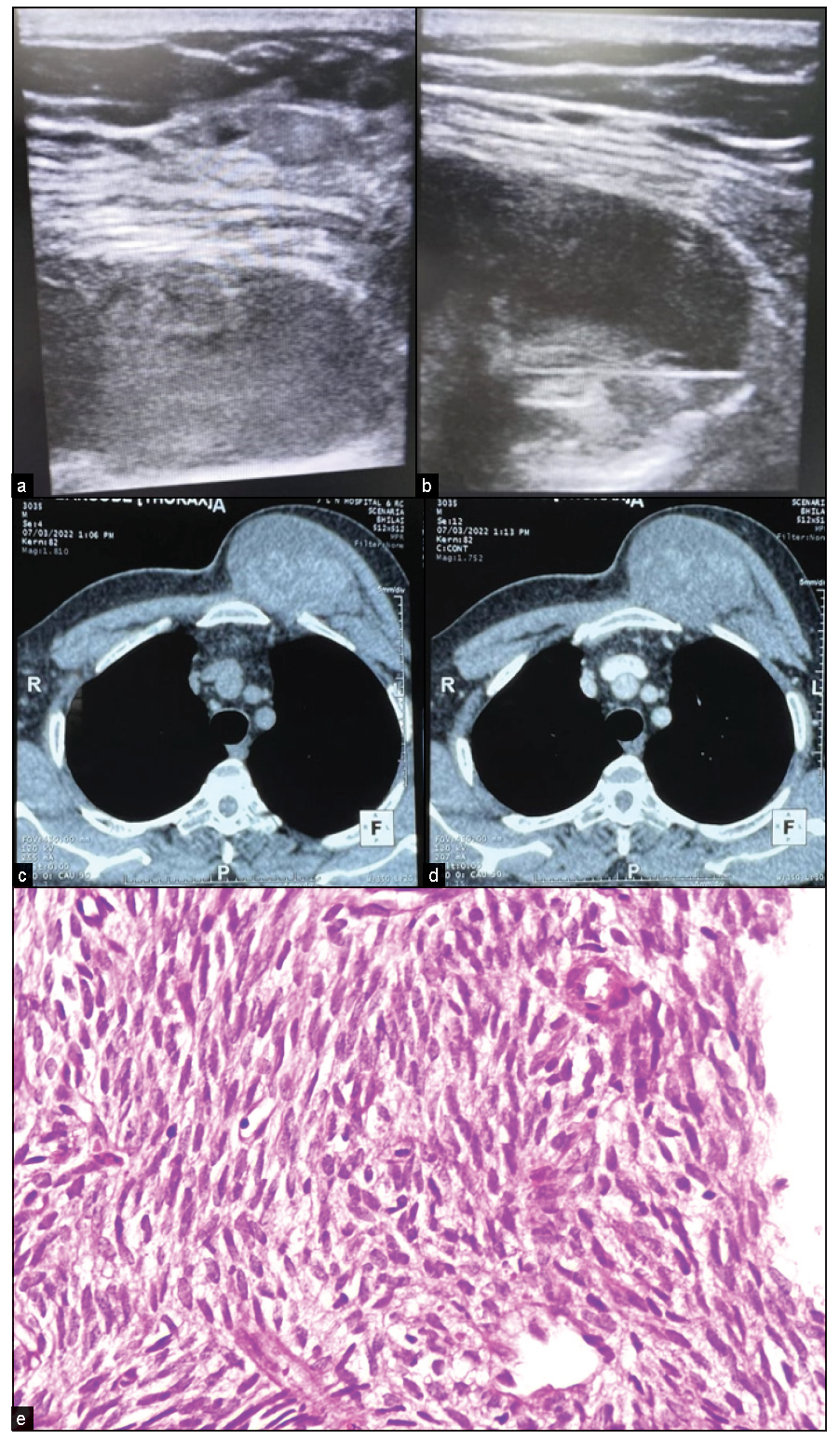 A case of synovial sarcoma of the chest wall. (a, b) Ultrasound images show a mixed echogenic lesion posterior to the pectoral muscle with a biopsy needle in a solid portion. (c, d) CT image showing mildly enhancing heterogeneous lesion arising from chest wall pushing pectoralis major anterolaterally while maintaining fat planes. (e) Histopathology shows spindle cell tumors with skeletal muscle fragments. Tumor cells expressing Vimentin, CD56, CD99, and BCL2 suggestive of synovial sarcoma.