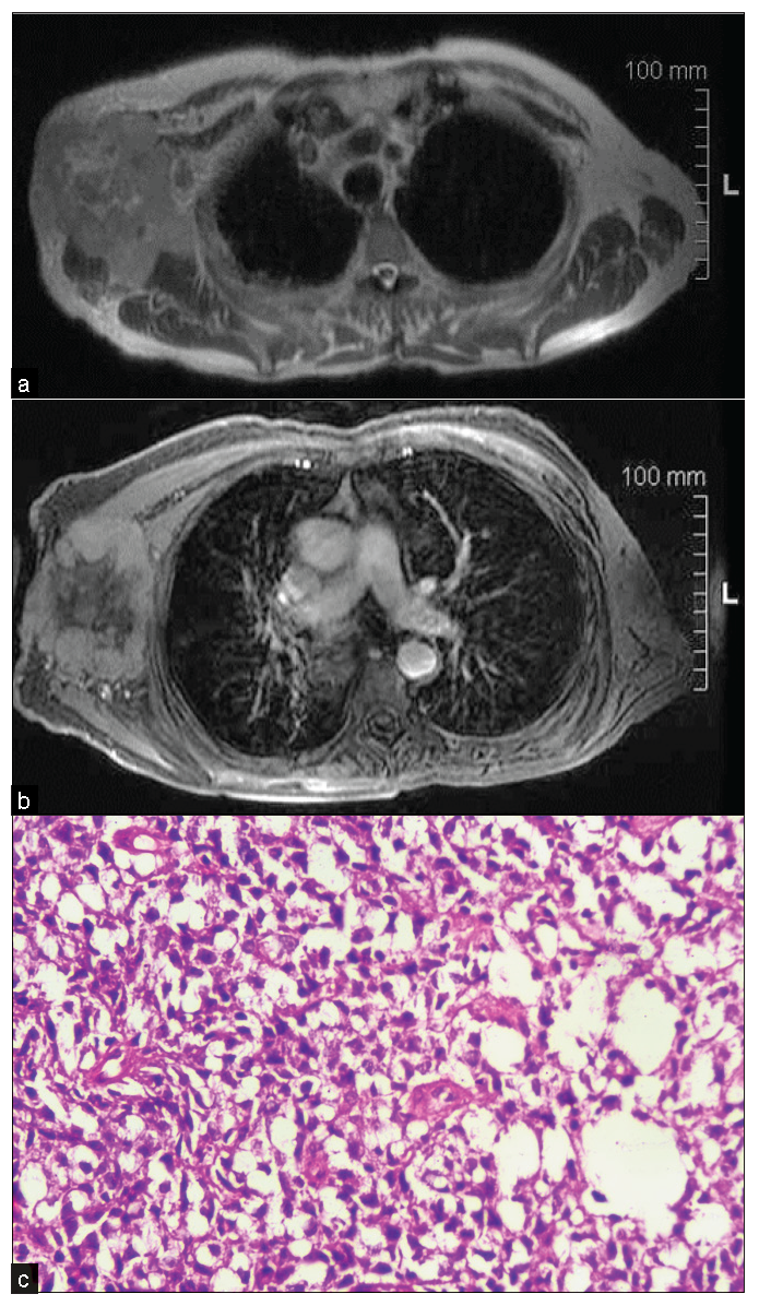 An 80-year-old male with a complaint of the right axillary lump for two months. (a) T2 WI MRI showing irregular heterogeneous mass with irregular margin, (b) heterogeneous post-contrast enhancement in the right axilla, lateral to pectoral major and minor muscle with subcutaneous fat edema and involvement of overlying skin. (c) On biopsy, it was diagnosed as a case of non-Hodgkin’s B cell lymphoma with BCL2 and BCL6 positivity. Histopathology shows a nest of polygonal cells, having granular to clear cytoplasm and round to oval nucleus.