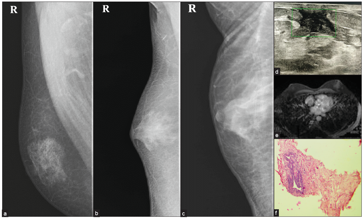 MLO views of different types of gynecomastia (a) Nodular, (b) Dendritic & (c) Diffuse glandular. (d) Dendritic type of gynecomastia on ultrasound showing typical spider leg appearance with no color flow. (e) MRI showing no contrast enhancement. (f) Histopathology shows a prominent duct surrounded by myxomatous stroma suggestive of gynecomastia.