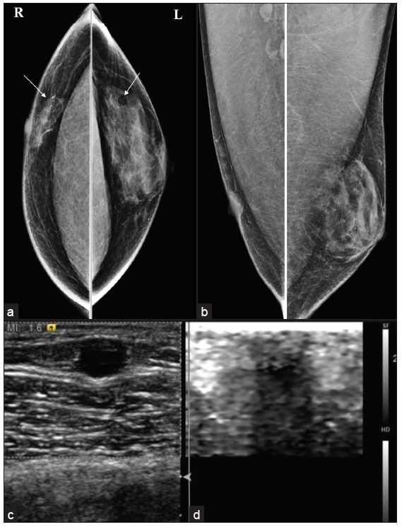 Postoperative case of bilateral gynecomastia with (a, b) recurrence of gynecomastia in the left breast and bilateral oil cyst (white arrows) seen in mammo and (c, d) Ultrasound with elastography.