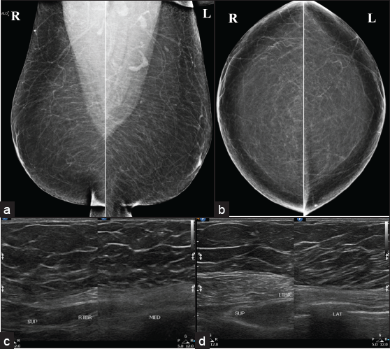 Bilateral pesudo gynecomastia seen as (a, b) diffuse adipose tissue proliferation without fibroglandular component in mammo and (c, d) ultrasound.