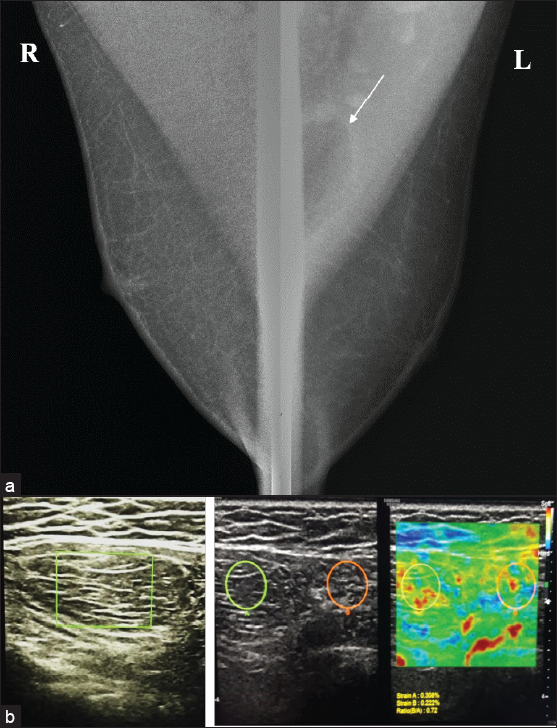 (a) Mammogram showing an oval shape radiolucent mass (white arrow) within the left pectoral muscle. (b) On ultrasound, it is seen as an isoechoic lesion with multiple thin echogenic septations parallel to the skin surface. On elastography, it is seen as a soft tissue mass with an e-strain of .72, suggestive of intramuscular lipoma.