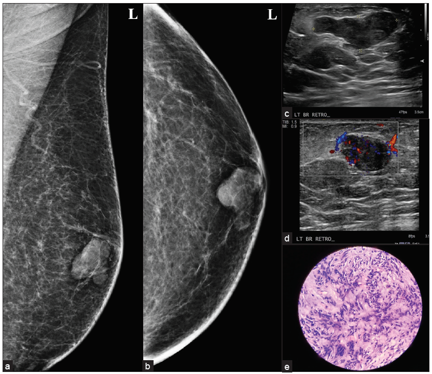 A 50-year male with a history of a palpable lump in the left breast, (a, b) myofibroblastoma presenting as an oval circumscribed, equal density retro-areolar eccentric mass on MLO and CC view. (c, d) Ultrasound showed an oval, circumscribed, hypoechoic lesion with parallel orientation, no posterior features and areas of vascularity within it, (e) histopathology showing spindle cell lesion consistent with mammary type myofibroblastoma.