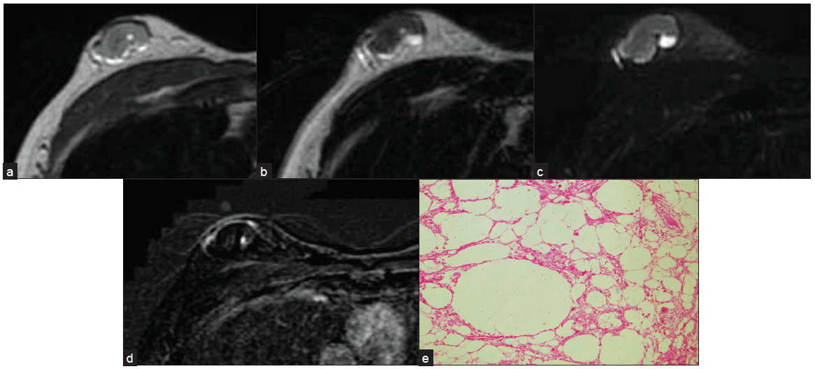 A biopsy-proven case of fat necrosis seen as an oval circumscribed, heterogeneous mass on (a) T1 and (b) T2W1 (c) with surrounding hyperintense rim, which is suppressed on T2 Fat Sat image (d) and no contrast enhancement seen on subtraction image. (e) Anucleated adipocytes seen suggestive of fat necrosis.