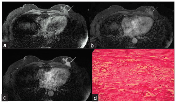 MRI showing an irregular-shaped, spiculated margin mass (white arrows seen in a-c) in the left breast in the posterior third region adjacent to the pectoral muscle. (a) Pre-contrast image. Dynamic post contrast scans reveal progressive enhancement (b) early, (c) delayed images (d) Histology composed of bundles of long sweeping and intersecting spindle cells with collagen tissues suggestive of fibromatosis.