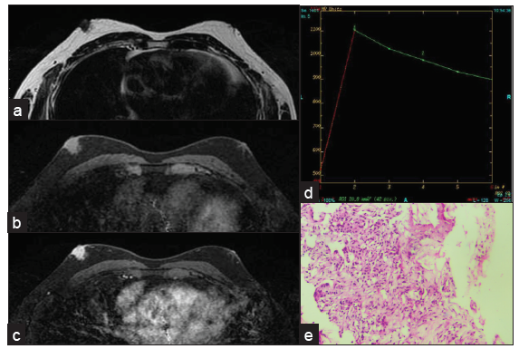 Grade 1 invasive ductal carcinoma in a 54-year-old male presenting as a nodular mass in the subareolar region showing intense contrast enhancement with type III curve. (a) T2W1 (b) Pre-contrast (c) post-contrast (d) kinetic curve. (e) Histopathology showing grade 1 IDC.