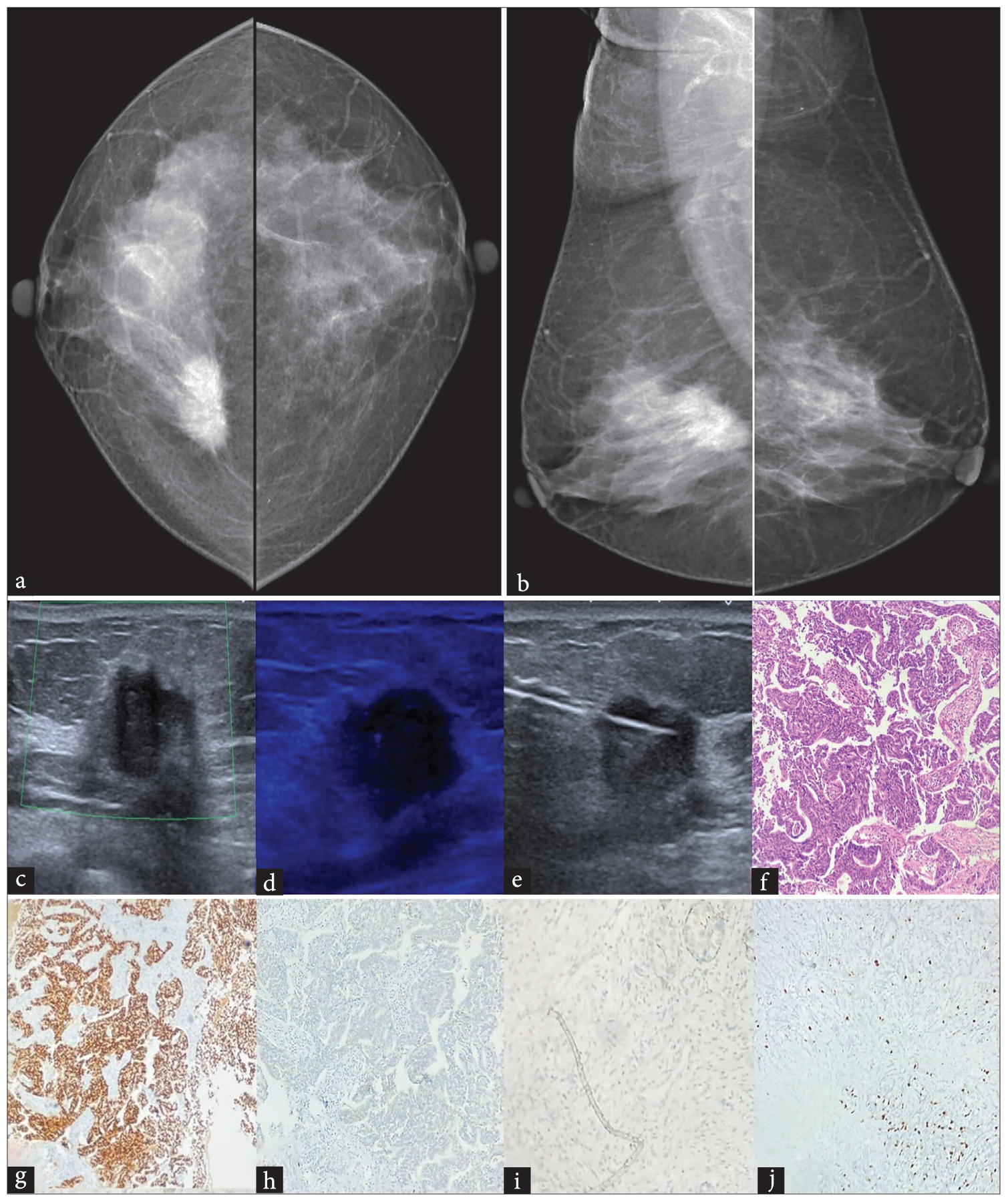 Luminal B breast cancer: Mammogram (a) CC and (b) MLO views of a 53-year-old female with Type B breast parenchyma showing an irregular high-density mass with spiculated margins in central inner quadrant of the right breast. (c) US shows an irregular anti-parallel oriented heterogeneously hypoechoic mass with angular margins and posterior shadowing in the right breast with no significant internal vascularity. (d) No calcifications seen within. (e) US guided Tru-cut biopsy image of the right breast mass. (f) Histopathology shows invasive mammary carcinoma, no special type, with islands of tumor cells. (H&E x 100). Tumor cells showing (g) ER positivity, (h) PgR positivity, (i) HER2 negativity and (j) Ki67 index >14 % (IHC x100). CC: Cranio-caudal, MLO: Mediolateral oblique, US: Ultrasound, H&E: Hematoxylin and eosin, ER: Estrogen receptor, PgR: Progesterone receptor, HER2: Human epidermal growth factor receptor 2, IHC: Immunohistochemistry.