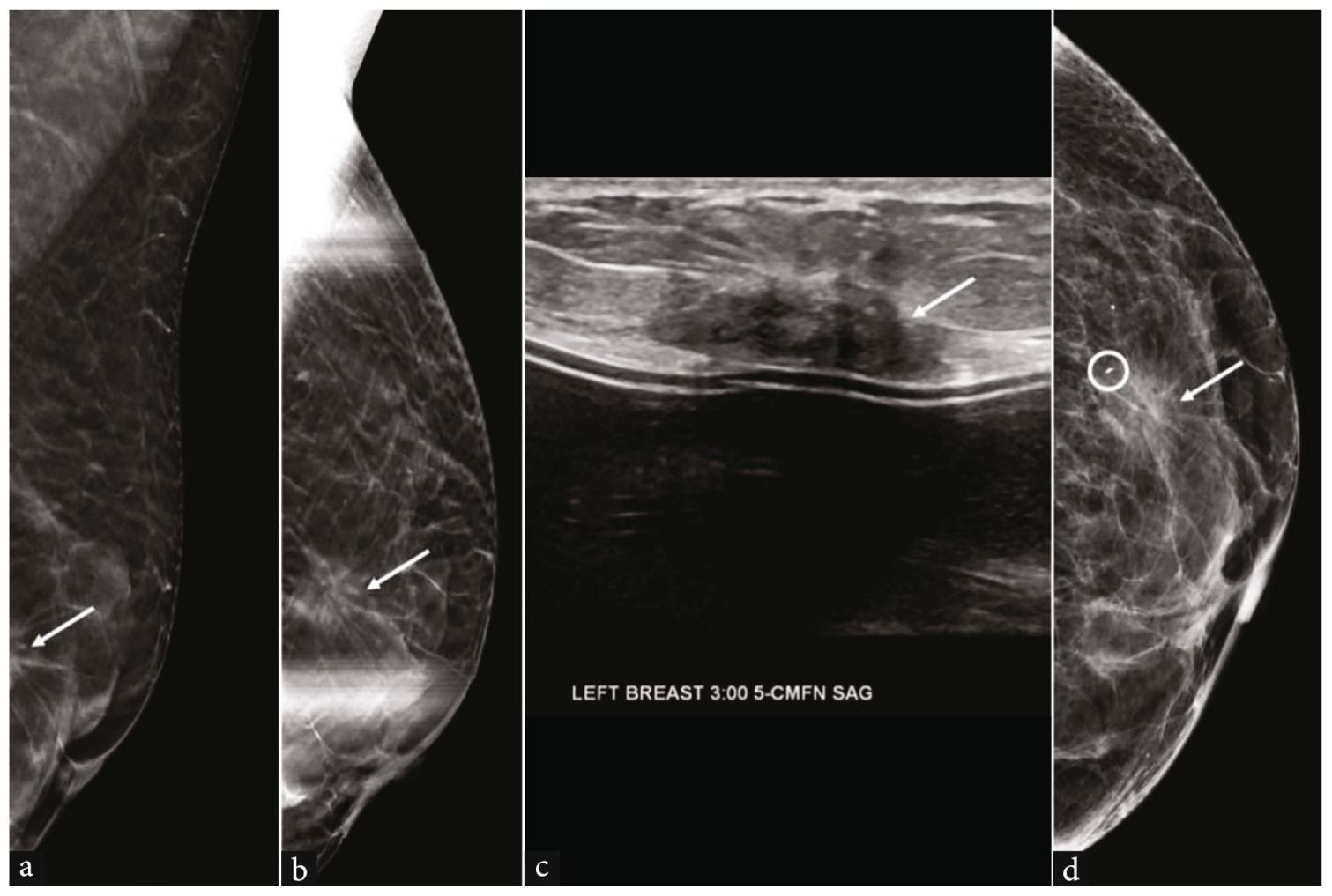 A 64-year-old woman with invasive ductal carcinoma (IDC) of the left breast. (a) Implant-displaced mediolateral oblique tomosynthesis image from the screening mammogram shows a mass in the left breast (white arrow), which is incompletely visualized. (b) Spot compression mediolateral oblique tomosynthesis image more completely shows the mass (white arrow). (c) Targeted ultrasound demonstrates a corresponding irregular hypoechoic mass in the left breast at 3 o’clock (white arrow). The mass was biopsied under ultrasound guidance. (d) Post-procedure mammogram shows that the biopsy marker (white circle) is located at the periphery of the mass (white arrow). The biopsy pathology result was benign breast tissue, which was deemed to be discordant. Stereotactic biopsy was subsequently performed, yielding grade 1 IDC.