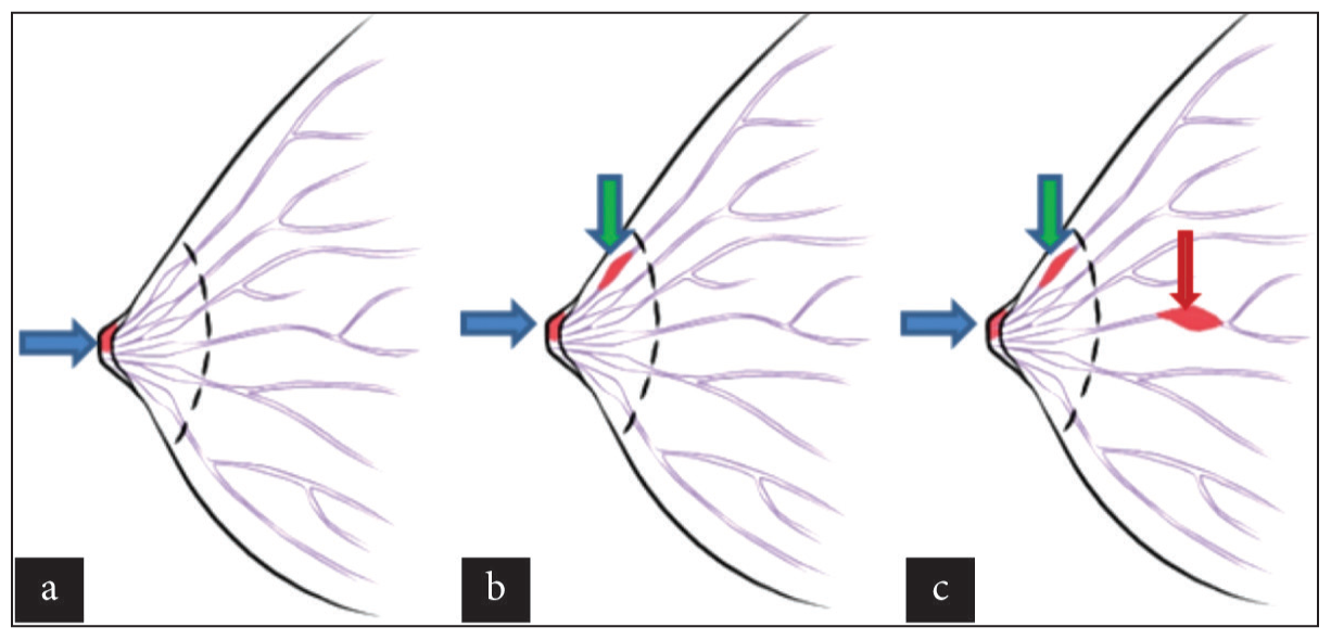 Diagrammatic representation of the various categories of Paget’s disease. (a) Paget’s disease of nipple without DCIS (blue arrow). (b) Paget’s disease of nipple (blue arrow) with DCIS in underlying lactiferous duct (green arrow). (c) Paget’s disease of the nipple with DCIS or invasive cancer in the breast at a distant location (red arrow) (at least 2 cm from the nipple-areolar complex) involving the nipple (blue arrow), involving underlying duct (green arrow).